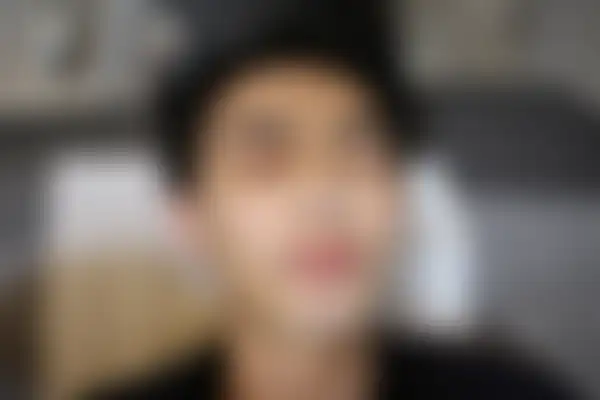 여드름 치료 후 사진 — 수원점, 치료 기간 5개월