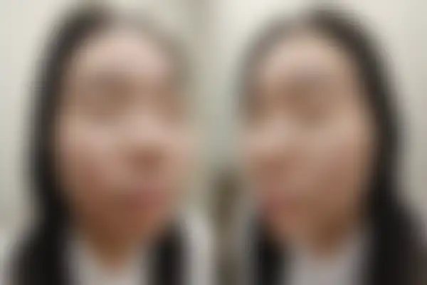 여드름 치료 후 사진 — 신도림점, 치료 기간 12개월