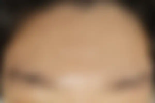 여드름 치료 후 사진 — 대전점, 치료 기간 6개월
