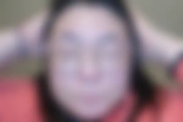 여드름 치료 후 사진 — 천안아산점, 치료 기간 4개월