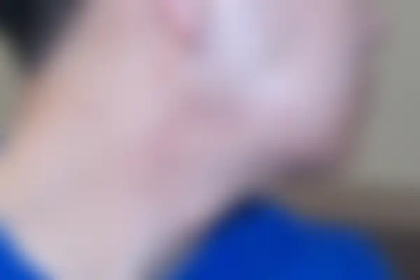 여드름 치료 후 사진 — 천안아산점, 치료 기간 5개월