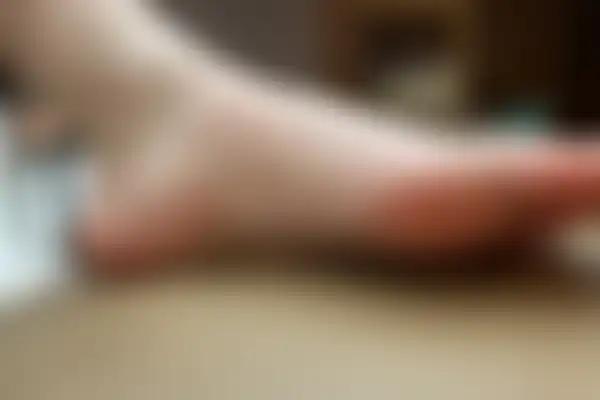 한포진 치료 후 사진 — 잠실점, 치료 기간 3개월