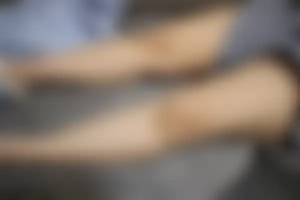 건선 치료 후 사진 — 수원점, 치료 기간 2개월