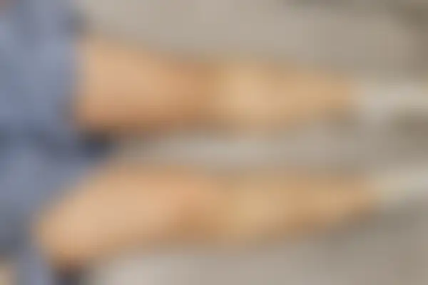 건선 치료 후 사진 — 마포공덕점, 치료 기간 6개월