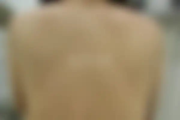두드러기 치료 후 사진 — 부산서면점, 치료 기간 3개월