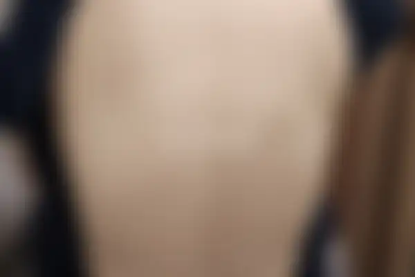 두드러기 치료 후 사진 — 대전점, 치료 기간 5개월