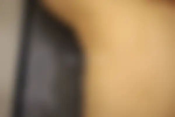 두드러기 치료 후 사진 — 안산점, 치료 기간 3개월