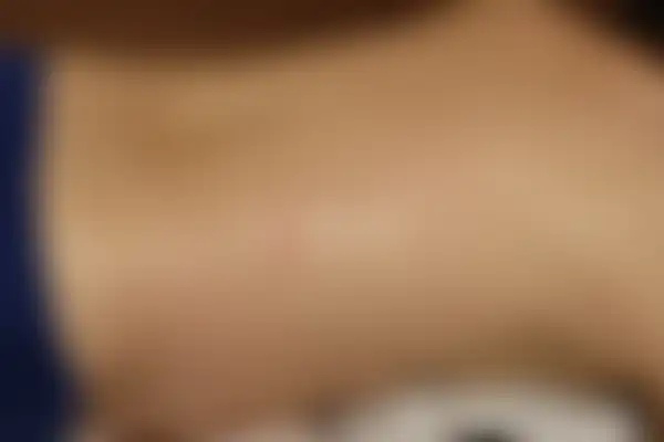 두드러기 치료 후 사진 — 분당점, 치료 기간 3개월