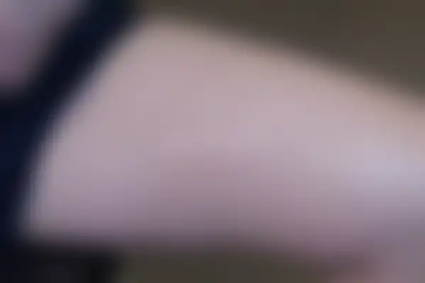 두드러기 치료 후 사진 — 천안아산점, 치료 기간 6개월