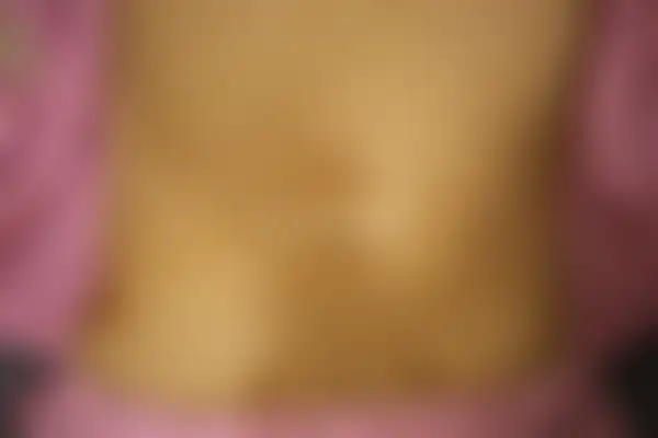 두드러기 치료 후 사진 — 안산점, 치료 기간 3개월
