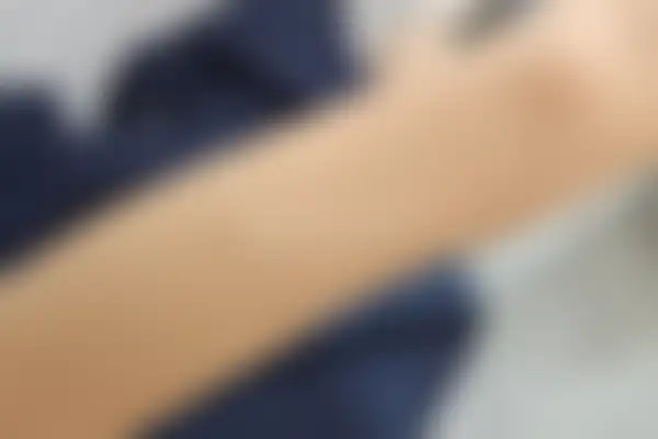 두드러기 치료 후 사진 — 대전점, 치료 기간 6개월