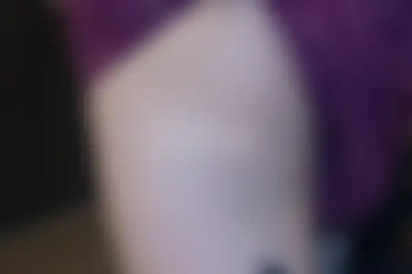 두드러기 치료 후 사진 — 천안아산점, 치료 기간 3개월