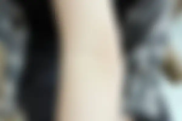 건선 치료 후 사진 — 잠실점, 치료 기간 5개월
