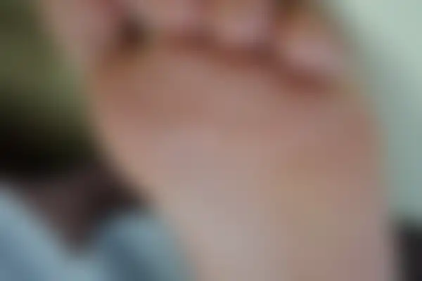 사마귀 치료 후 사진 — 잠실점, 치료 기간 4개월