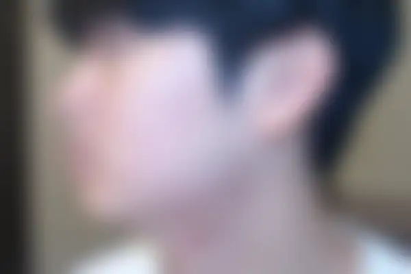 여드름 치료 후 사진 — 천안아산점, 치료 기간 6개월