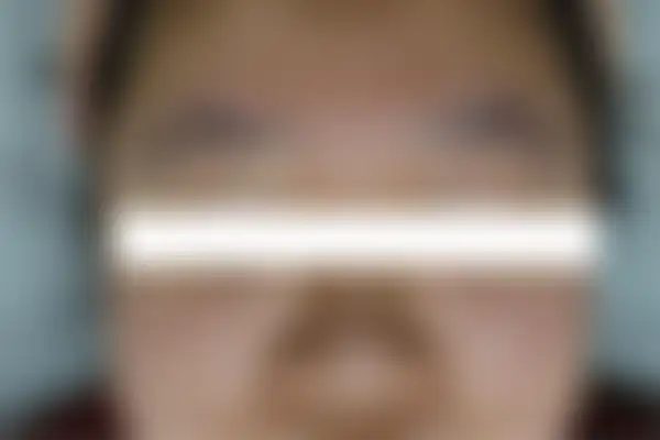 여드름 치료 후 사진 — 부천점, 치료 기간 2개월