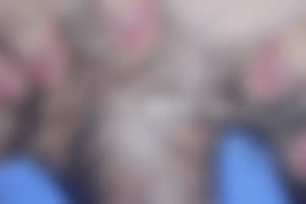 곤지름 치료 후 사진 — 천안아산점, 치료 기간 3개월