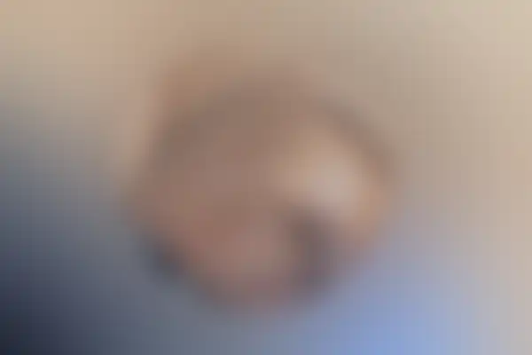 곤지름 치료 후 사진 — 천안아산점, 치료 기간 3개월