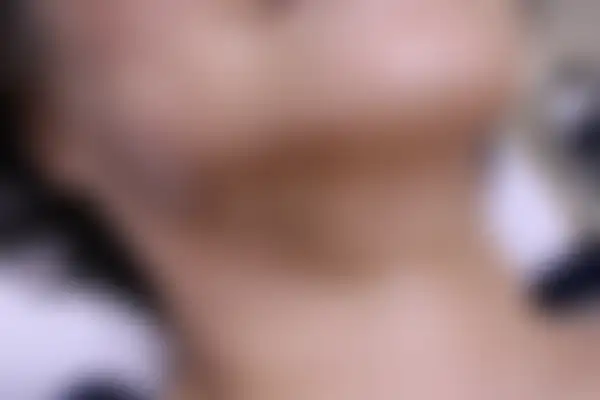 안면홍조 치료 후 사진 — 인천점, 치료 기간 4개월