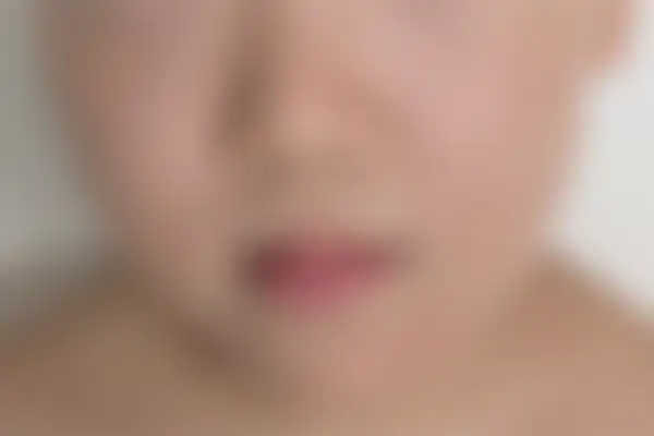 안면홍조 치료 후 사진 — 창원점, 치료 기간 5개월