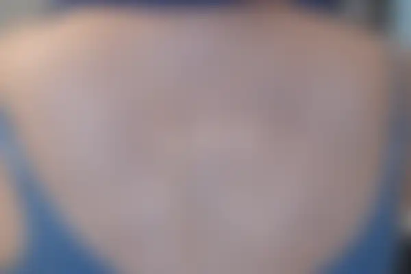 아토피 치료 후 사진 — 천안아산점, 치료 기간 7개월