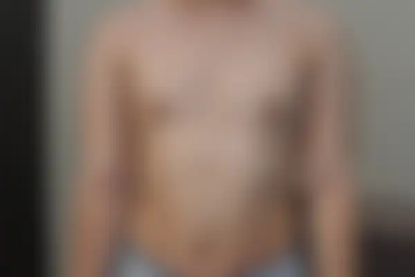 아토피 치료 후 사진 — 천안아산점, 치료 기간 3개월