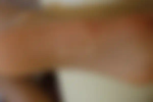 사마귀 치료 후 사진 — 잠실점, 치료 기간 4개월