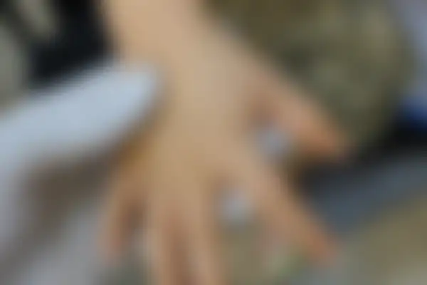 소아아토피 치료 후 사진 — 노원점, 치료 기간 4개월