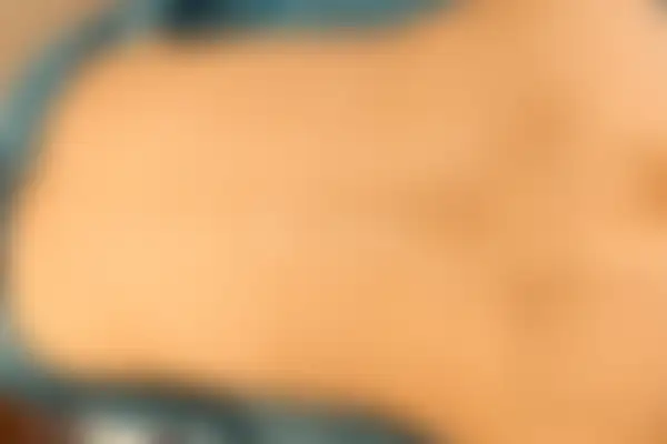 습진 치료 후 사진 — 부산센텀점, 치료 기간 3개월