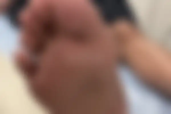 습진 치료 후 사진 — 부산서면점, 치료 기간 6개월