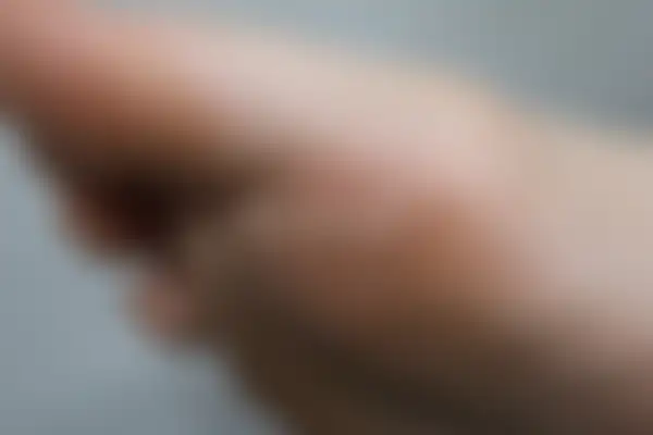 사마귀 치료 후 사진 — 대전점, 치료 기간 3개월