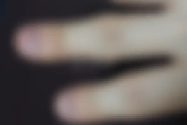 사마귀 치료 후 사진 — 대전점, 치료 기간 12개월