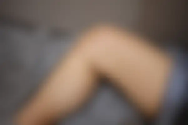 편평사마귀 치료 후 사진 — 수원점, 치료 기간 6개월