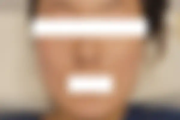 지루성피부염 치료 후 사진 — 마포공덕점, 치료 기간 6개월