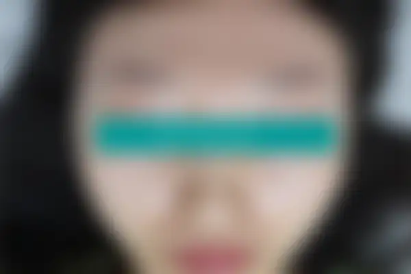 지루성피부염 치료 후 사진 — 부천점, 치료 기간 5개월