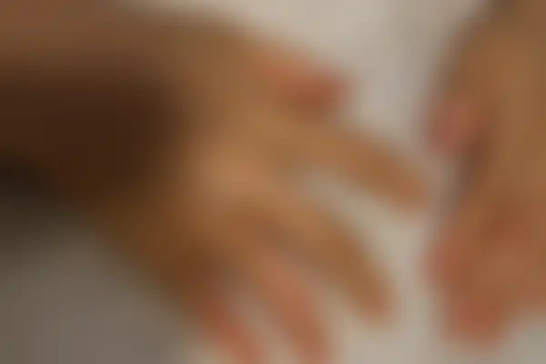 한포진 치료 후 사진 — 분당점, 치료 기간 3개월