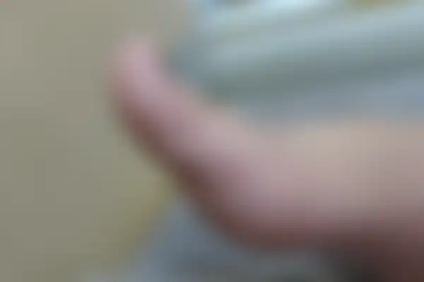 한포진 치료 후 사진 — 일산점, 치료 기간 3개월