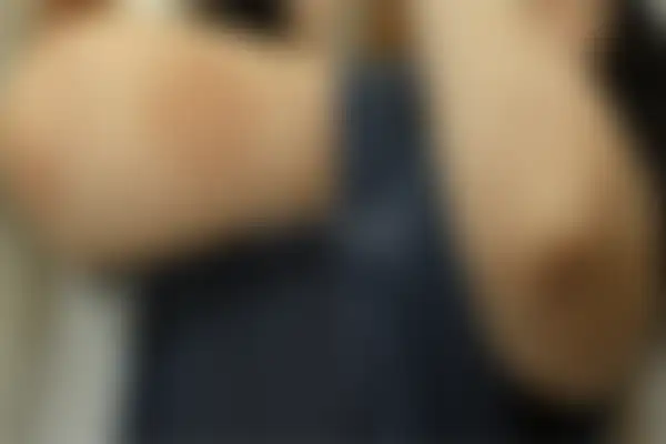 건선 치료 후 사진 — 부천점, 치료 기간 4개월