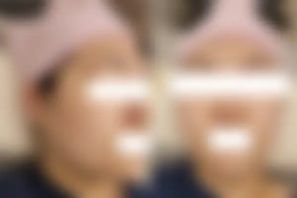 여드름 치료 후 사진 — 마포공덕점, 치료 기간 6개월