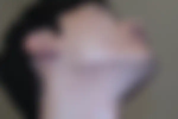 여드름 치료 후 사진 — 천안아산점, 치료 기간 5개월