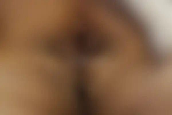 곤지름 치료 후 사진 — 대구점, 치료 기간 5개월