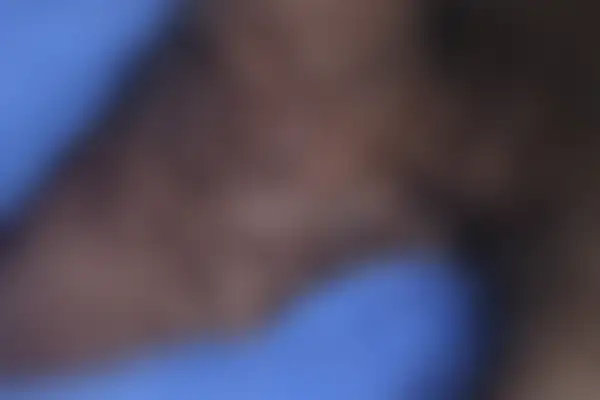 곤지름 치료 후 사진 — 천안아산점, 치료 기간 3개월