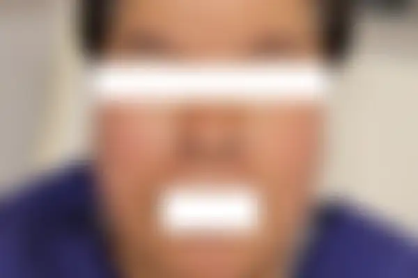 안면홍조 치료 후 사진 — 마포공덕점, 치료 기간 3개월