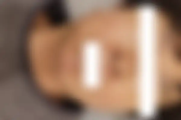 안면홍조 치료 후 사진 — 마포공덕점, 치료 기간 3개월