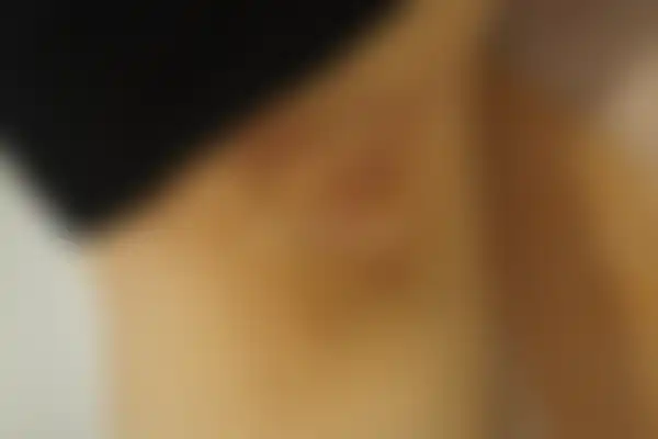 화농성한선염 치료 후 사진 — 대구점, 치료 기간 2개월