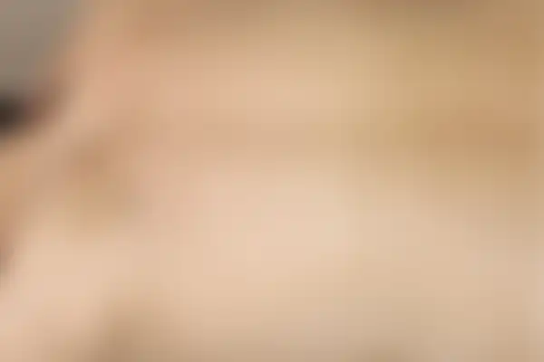 습진 치료 후 사진 — 수원점, 치료 기간 2개월