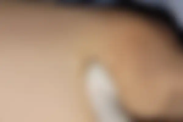 습진 치료 후 사진 — 마포공덕점, 치료 기간 8개월