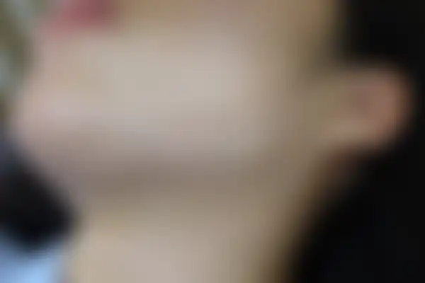 습진 치료 후 사진 — 일산점, 치료 기간 3개월