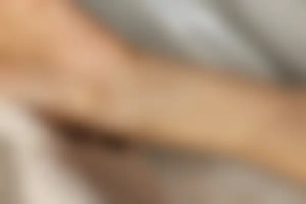 습진 치료 후 사진 — 마포공덕점, 치료 기간 4개월