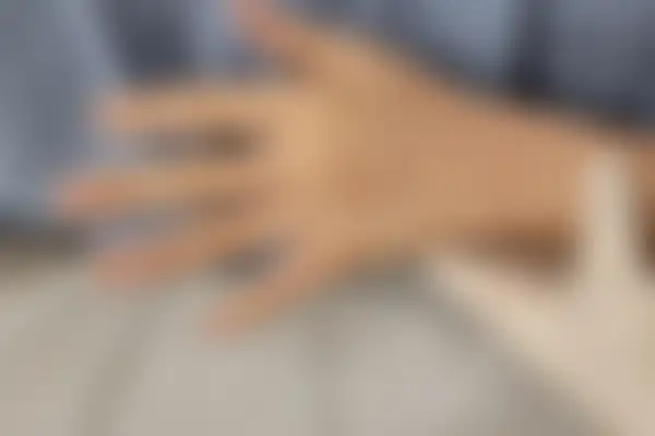 습진 치료 후 사진 — 마포공덕점, 치료 기간 6개월